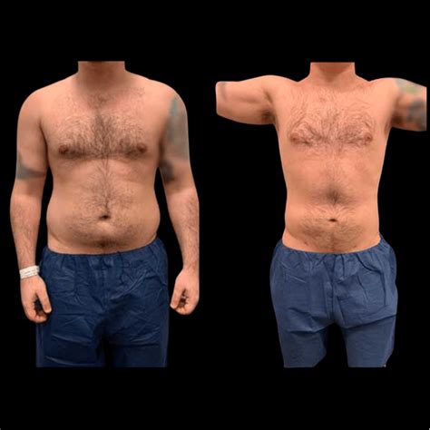 Best Male Liposuction Miami, FL 